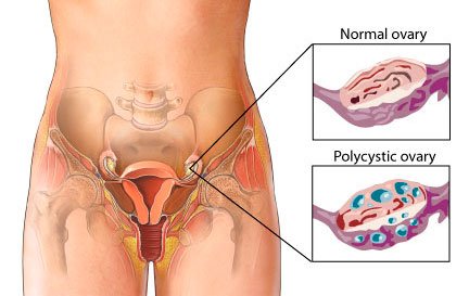 pierderea în greutate pentru ovarele polichistice